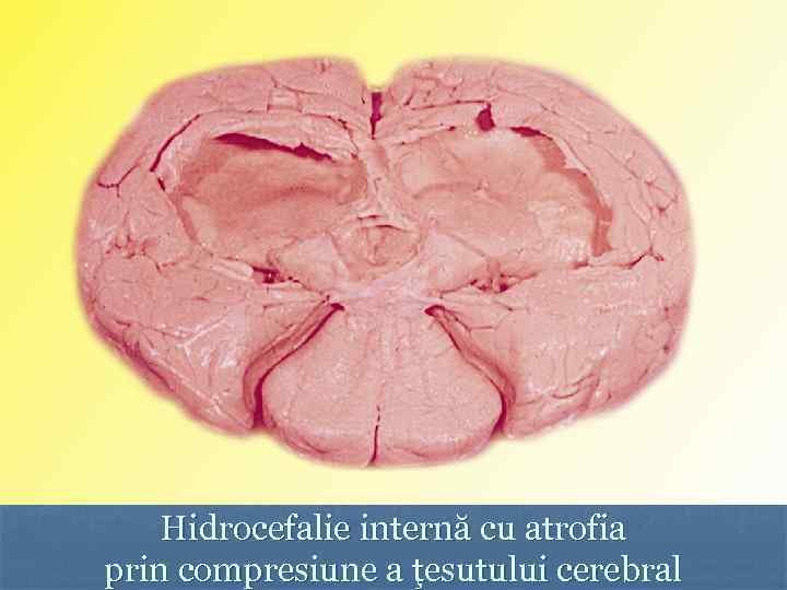 Hidrocefalie internă cu atrofia prin compresiune a ţesutului cerebral 