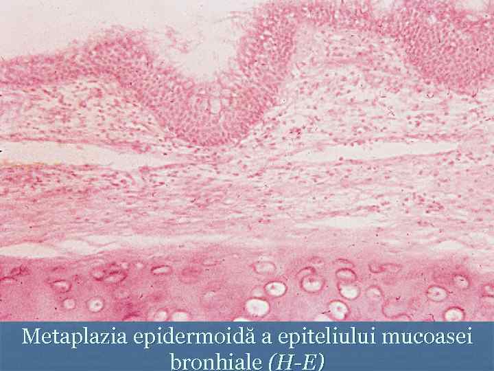 Metaplazia epidermoidă a epiteliului mucoasei bronhiale (H-E) 