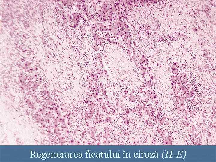 Regenerarea ficatului în ciroză (H-E) 