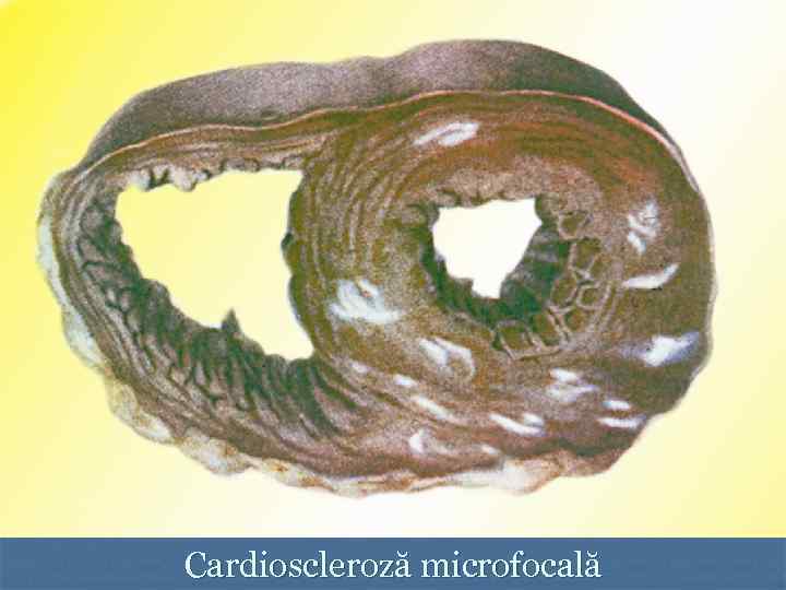 Cardioscleroză microfocală 