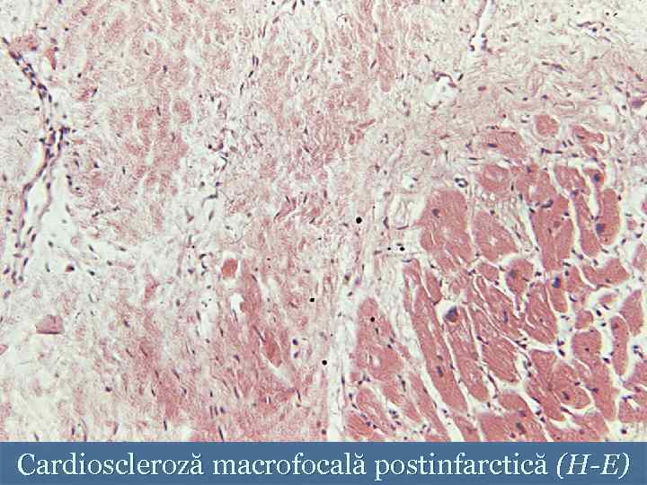 Cardioscleroză macrofocală postinfarctică (H-E) 