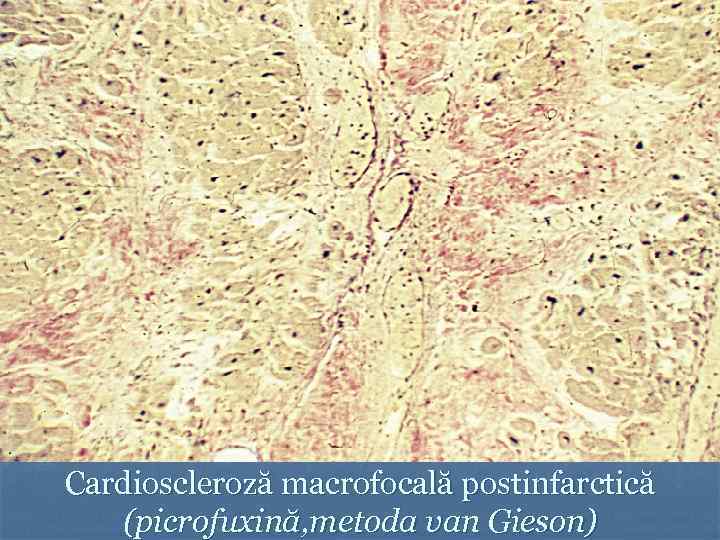 Cardioscleroză macrofocală postinfarctică (picrofuxină, metoda van Gieson) 