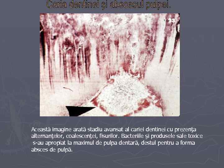Această imagine arată stadiu avansat al cariei dentinei cu prezenţa alternanţelor, coalescenţei, fisurilor. Bacteriile