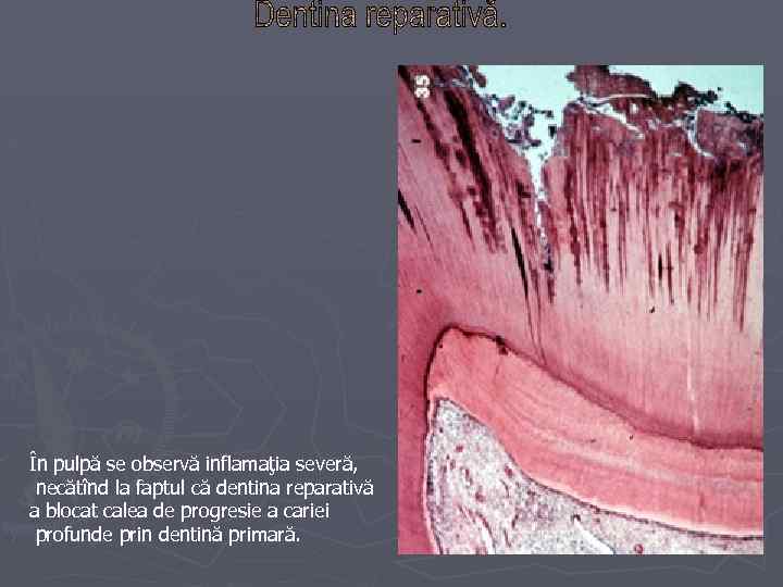 În pulpă se observă inflamaţia severă, necătînd la faptul că dentina reparativă a blocat
