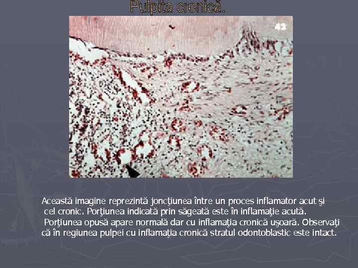 Această imagine reprezintă joncţiunea între un proces inflamator acut şi cel cronic. Porţiunea indicată