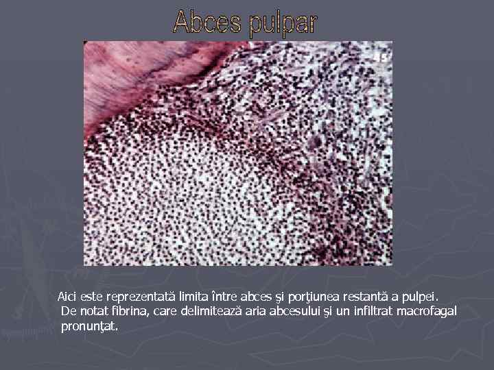 Aici este reprezentată limita între abces şi porţiunea restantă a pulpei. De notat fibrina,