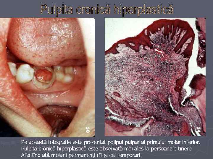 Pe această fotografie este prezentat polipul pulpar al primului molar inferior. Pulpita cronică hiperplastică