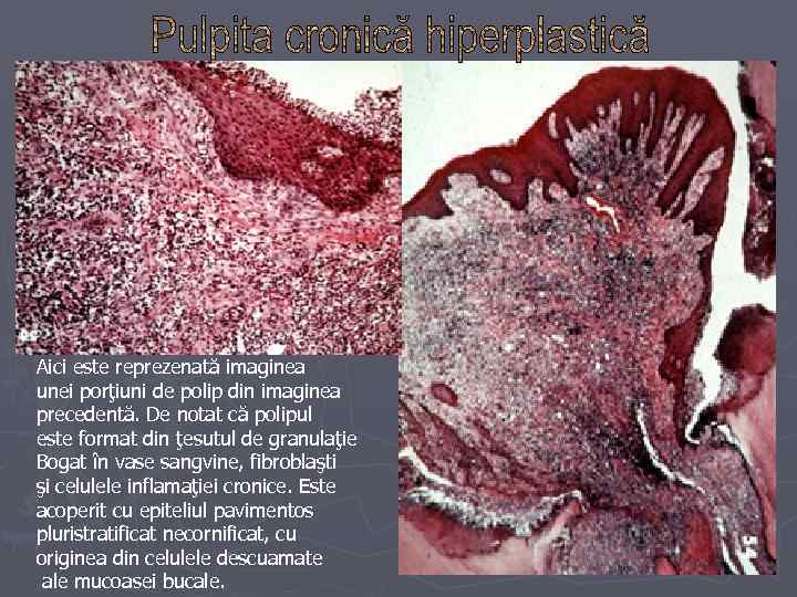 Aici este reprezenată imaginea unei porţiuni de polip din imaginea precedentă. De notat că