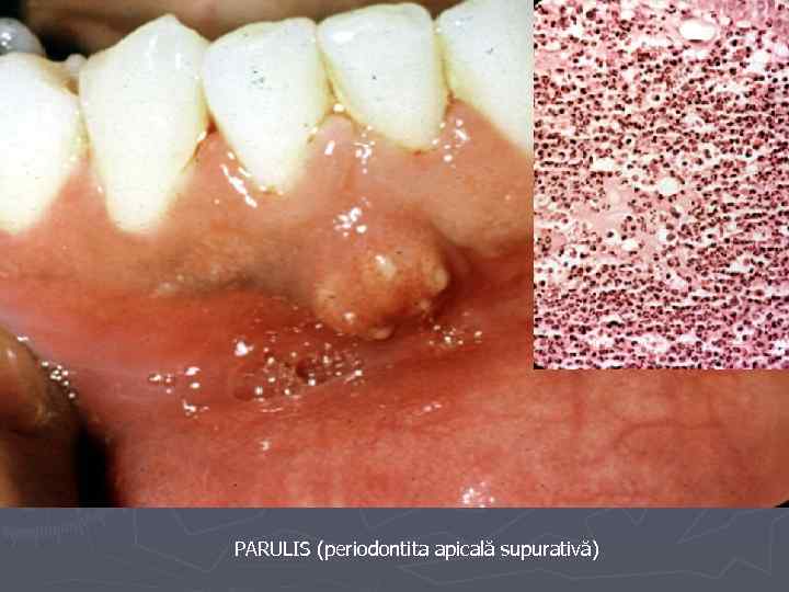 PARULIS (periodontita apicală supurativă) 