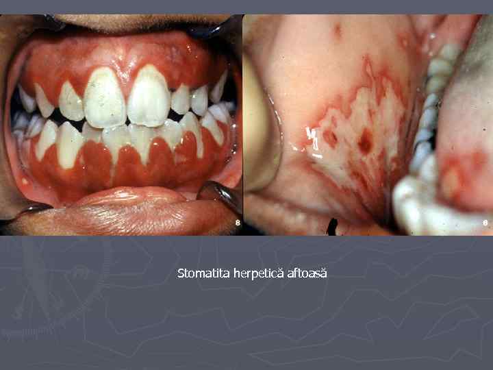 Stomatita herpetică aftoasă 