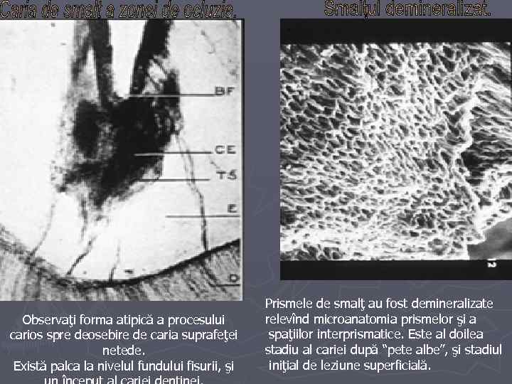 Observaţi forma atipică a procesului carios spre deosebire de caria suprafeţei netede. Există palca