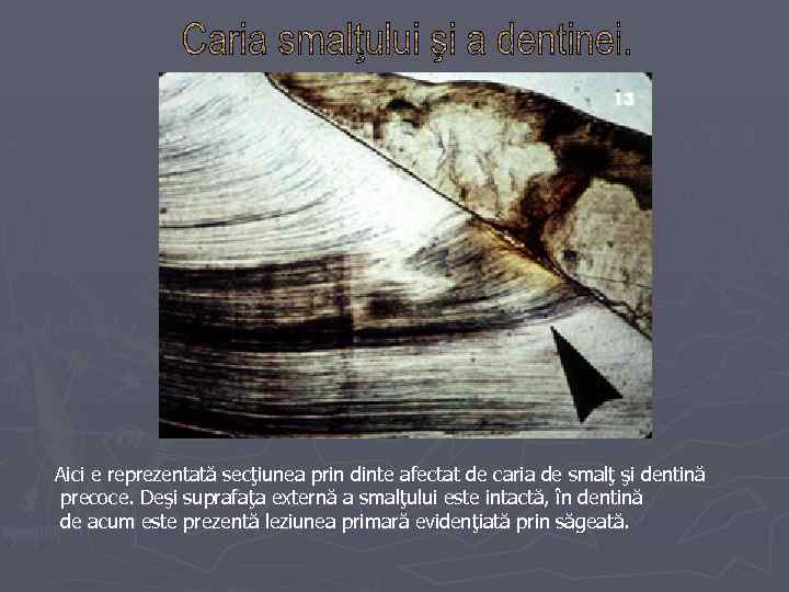 Aici e reprezentată secţiunea prin dinte afectat de caria de smalţ şi dentină precoce.