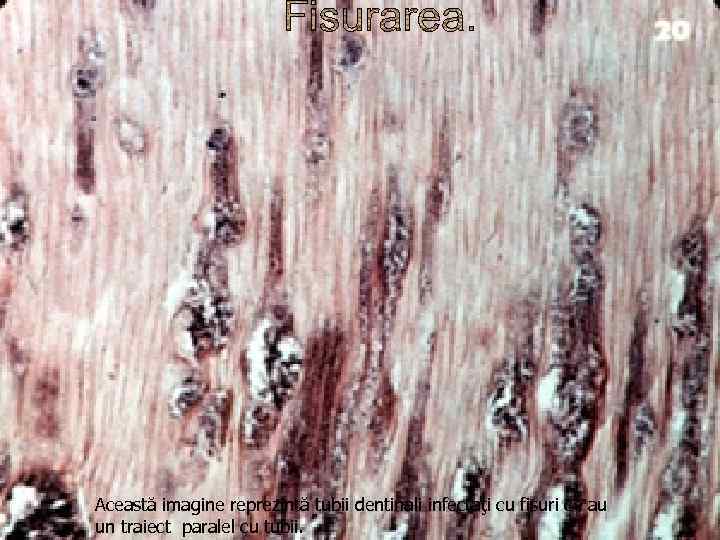 Această imagine reprezintă tubii dentinali infectaţi cu fisuri ce au un traiect paralel cu