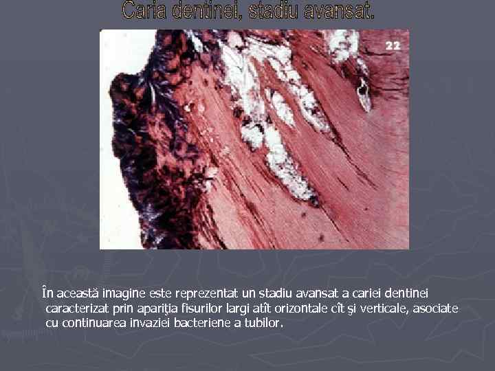În această imagine este reprezentat un stadiu avansat a cariei dentinei caracterizat prin apariţia