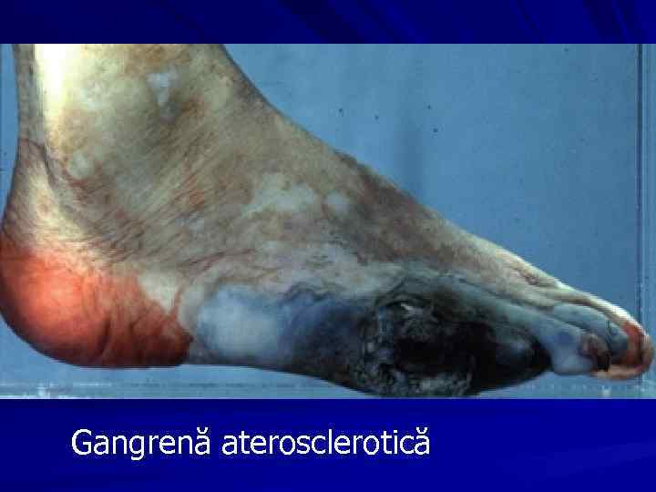 Gangrenă aterosclerotică 