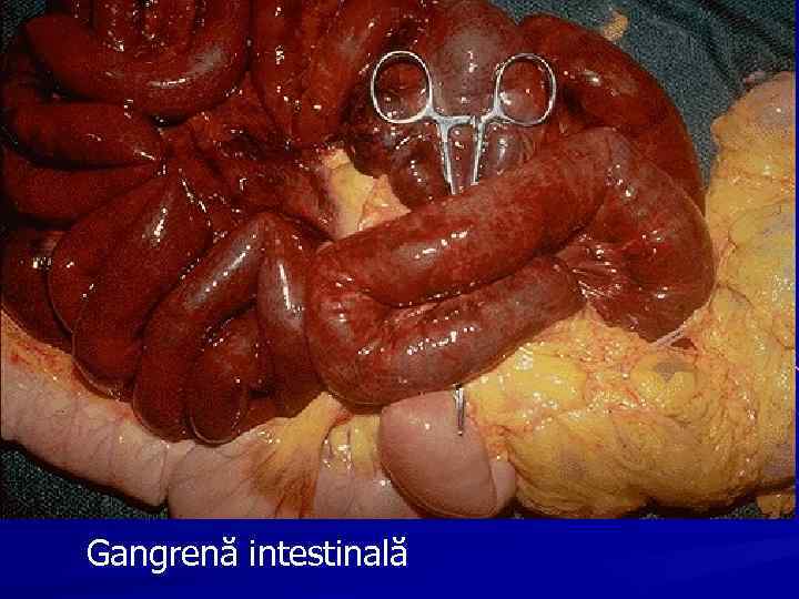 Gangrenă intestinală 