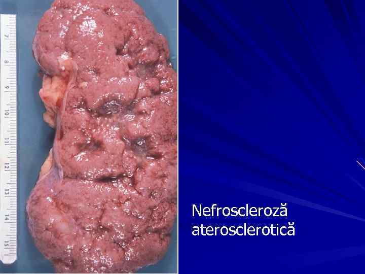 Nefroscleroză aterosclerotică 