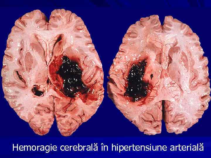 Hemoragie cerebrală în hipertensiune arterială 