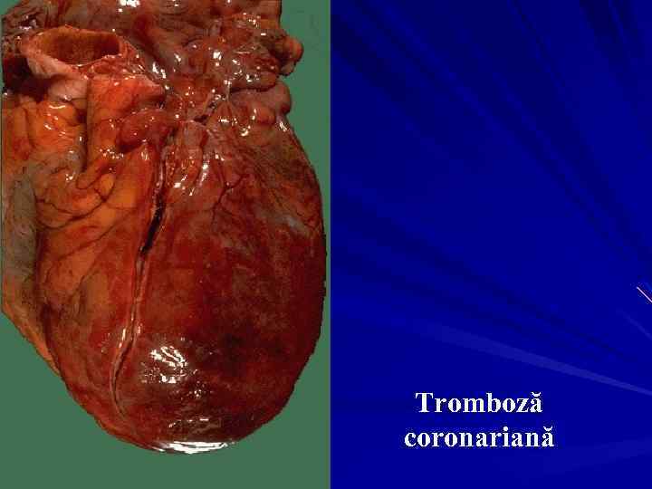 Tromboză coronariană 