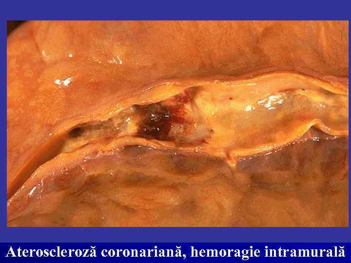 Ateroscleroză coronariană, hemoragie intramurală 