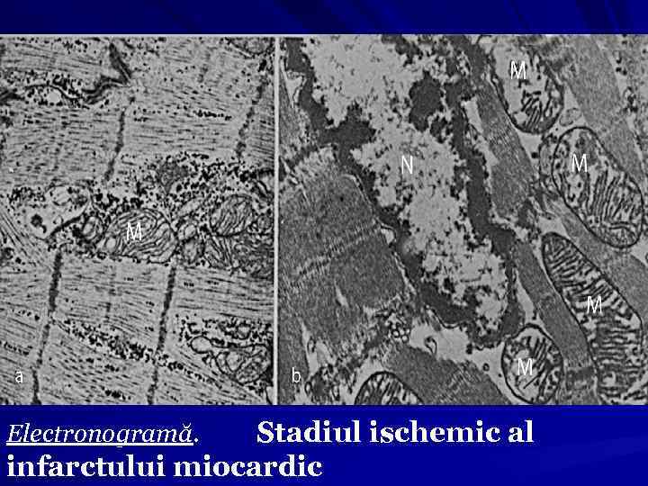Electronogramă. Stadiul ischemic al infarctului miocardic 