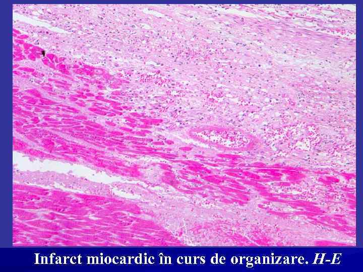 Infarct miocardic în curs de organizare. H-E 