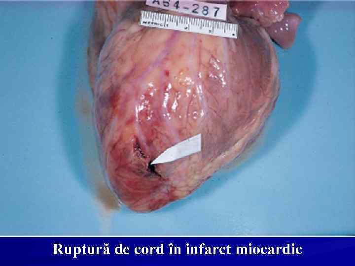 Ruptură de cord în infarct miocardic 