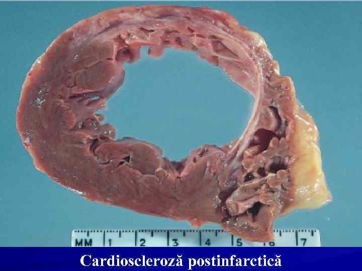 Cardioscleroză postinfarctică 