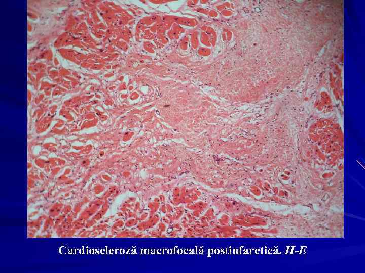 Cardioscleroză macrofocală postinfarctică. H-E 