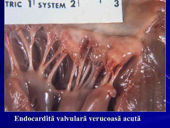 Endocardită valvulară verucoasă acută 