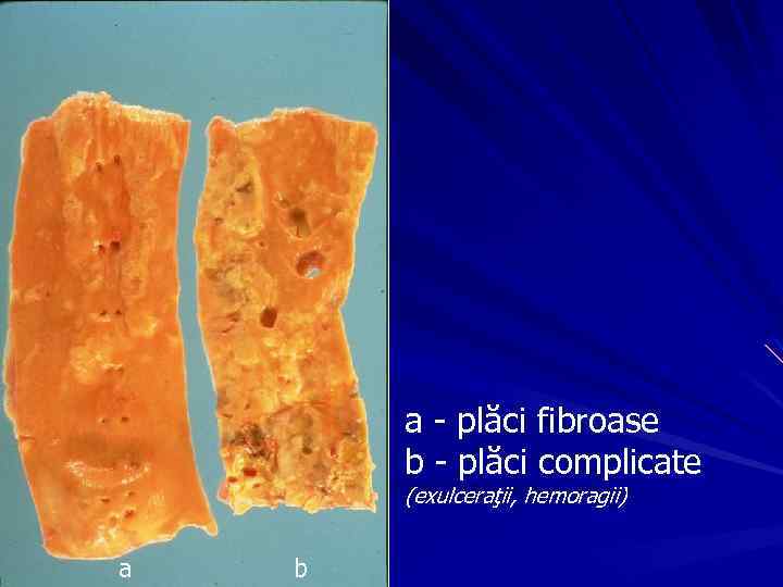 a - plăci fibroase b - plăci complicate (exulceraţii, hemoragii) a b 