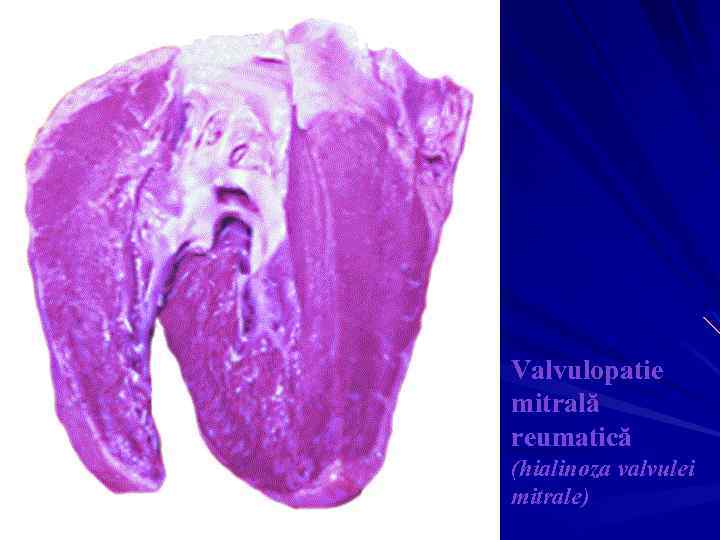 Valvulopatie mitrală reumatică (hialinoza valvulei mitrale) 