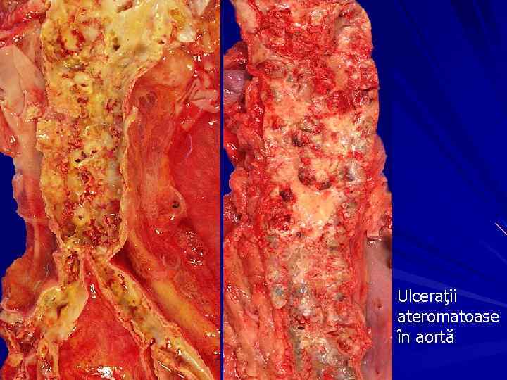 Ulceraţii ateromatoase în aortă 
