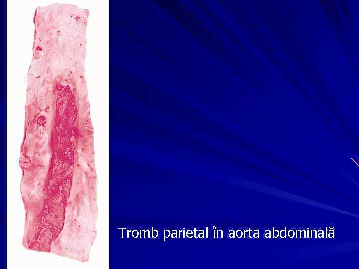 Tromb parietal în aorta abdominală 