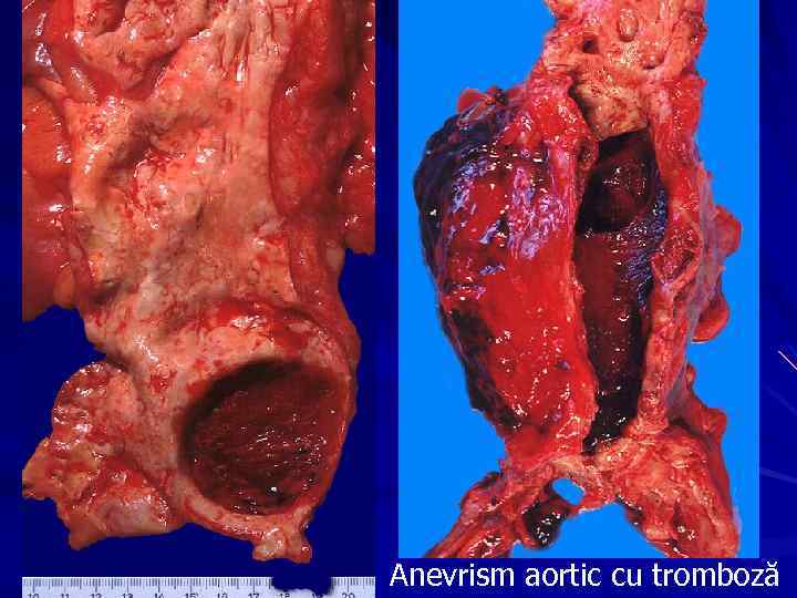 Anevrism aortic cu tromboză 