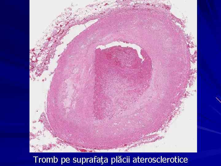 Tromb pe suprafaţa plăcii aterosclerotice 