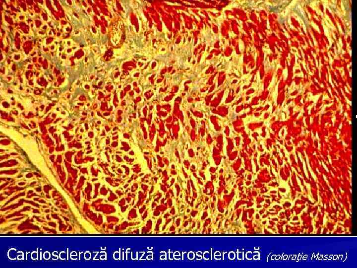 Cardioscleroză difuză aterosclerotică (coloraţie Masson) 