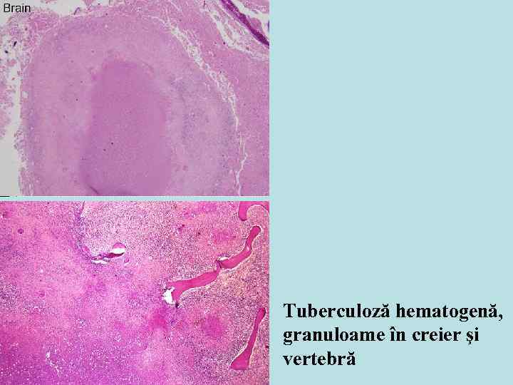 Tuberculoză hematogenă, granuloame în creier şi vertebră 