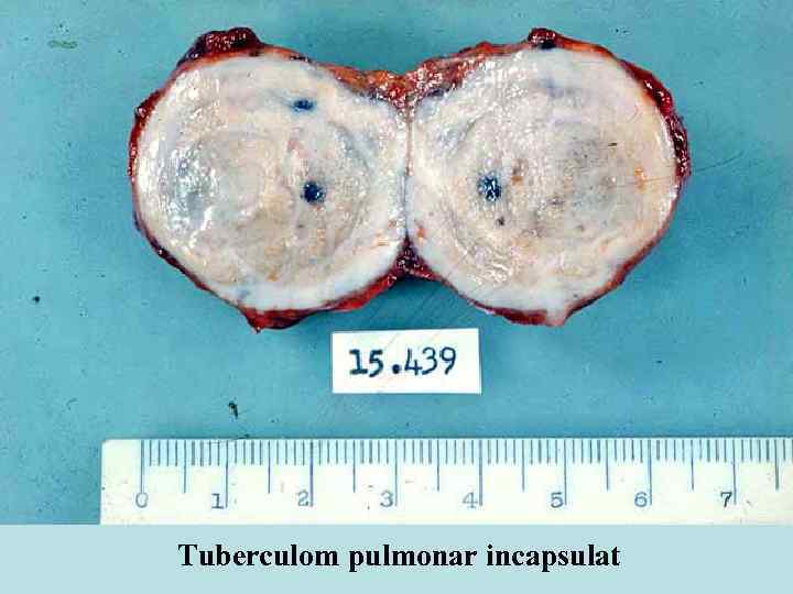 Tuberculom pulmonar incapsulat 