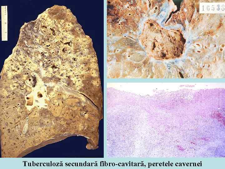 Tuberculoză secundară fibro-cavitară, peretele cavernei 