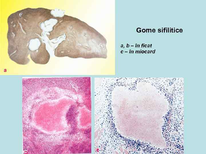 Gome sifilitice a, b – în ficat c – în miocard a b c