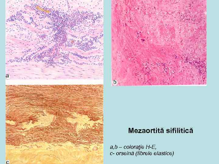 a b Mezaortită sifilitică a, b – coloraţie H-E, c- orseină (fibrele elastice) c