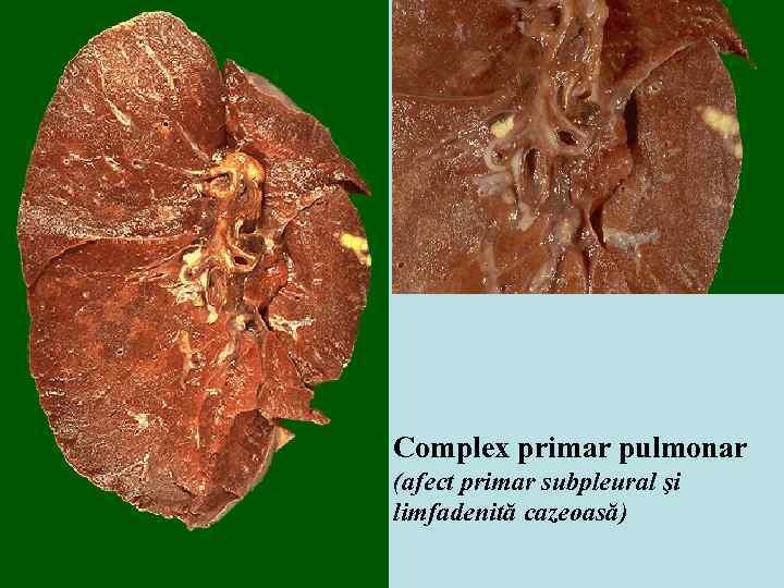 Complex primar pulmonar (afect primar subpleural şi limfadenită cazeoasă) 