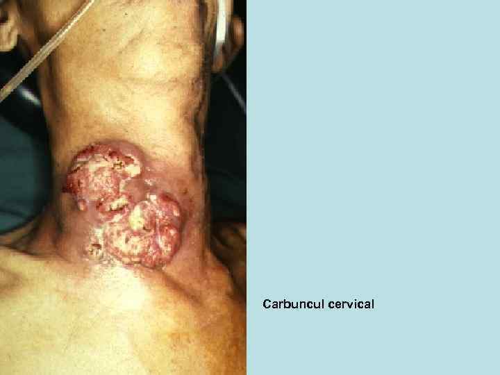 Carbuncul cervical 