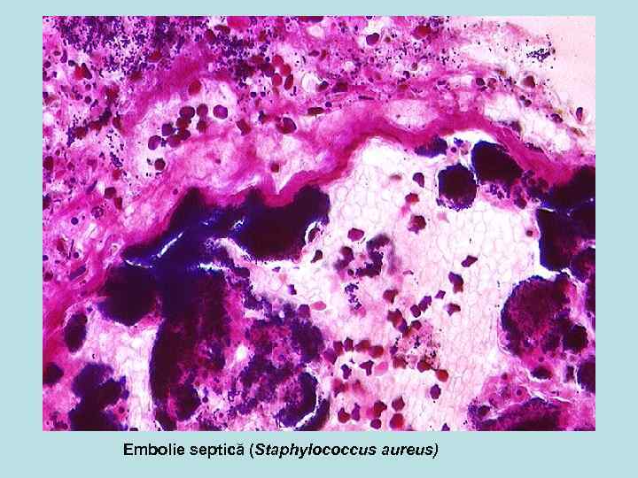 Embolie septică (Staphylococcus aureus) 