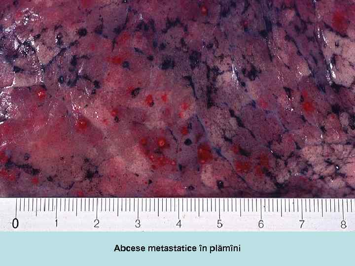 Abcese metastatice în plămîni 