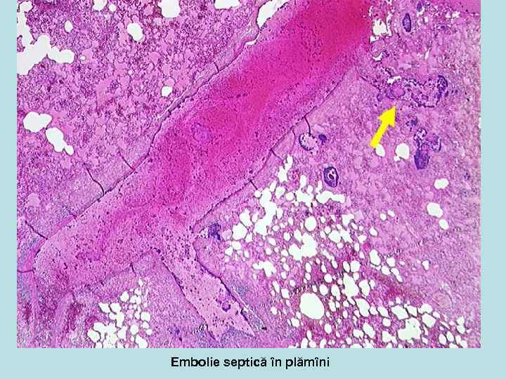 Embolie septică în plămîni 