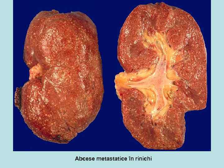 Abcese metastatice în rinichi 