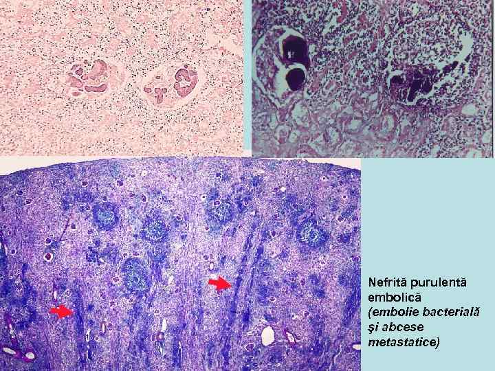 Nefrită purulentă embolică (embolie bacterială şi abcese metastatice) 