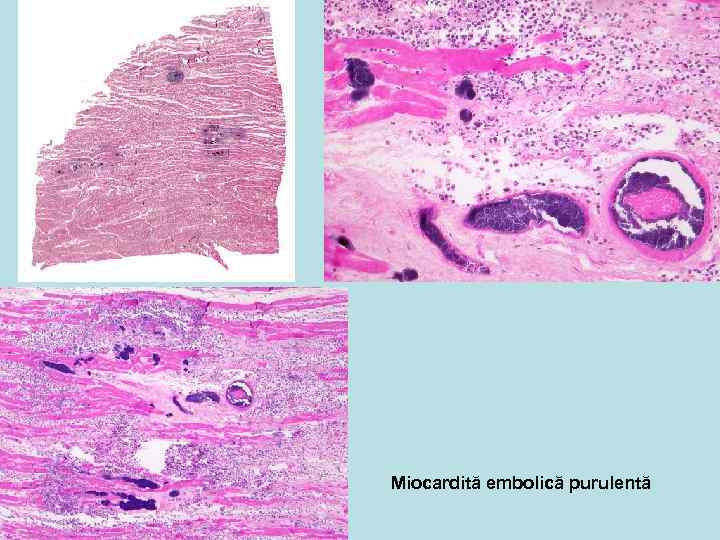 Miocardită embolică purulentă 